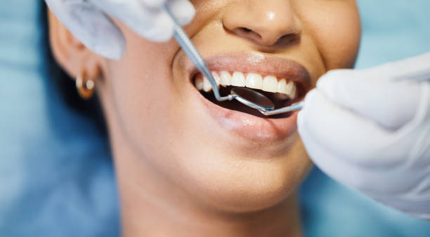 Best Knocked-Out Tooth (Avulsed Tooth) Treatment in Jacksonville, TX